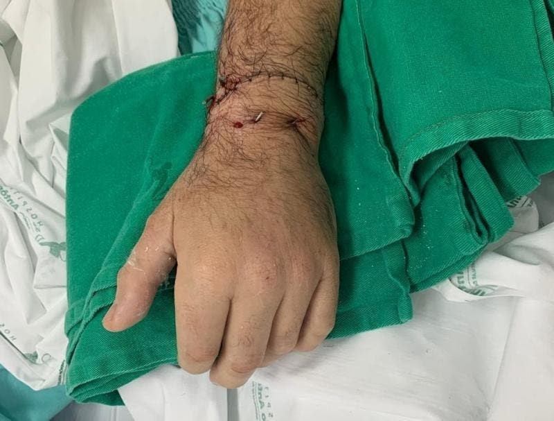 Em cirurgia rara, mão de homem é reimplantada após ser amputada em briga, em Blumenau