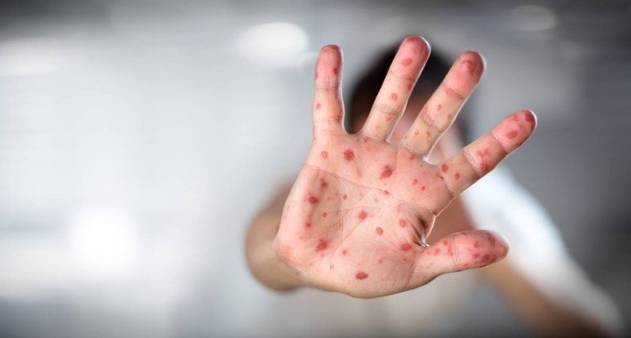 Primeiro caso de varíola dos macacos no Brasil é confirmado em São Paulo