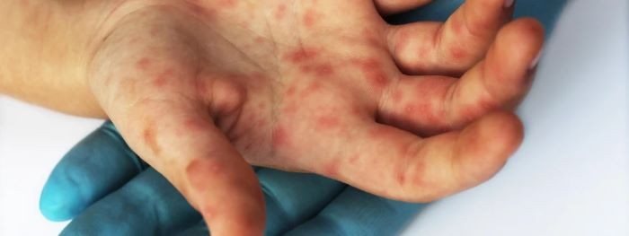 SC anuncia plano de contingência de prevenção à varíola dos macacos
