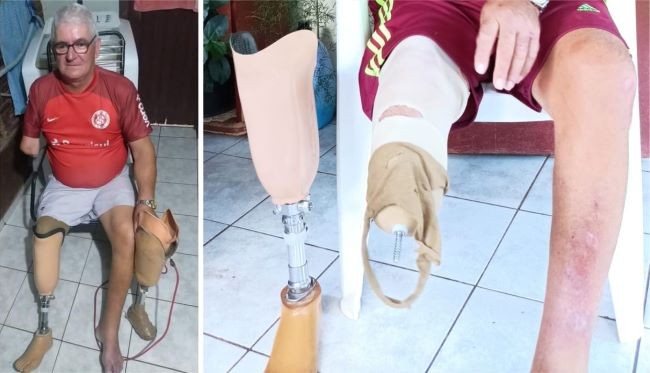 Família de Miguel Ledur pede ajuda para manutenção de prótese