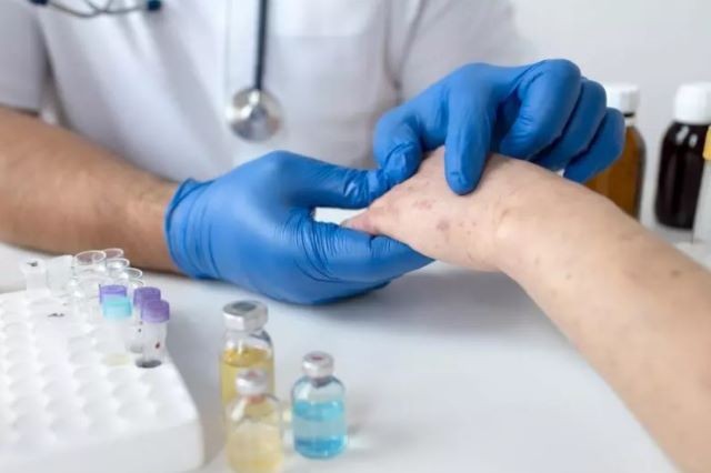 SC tem previsão para receber 984 doses da vacina contra a varíola dos macacos