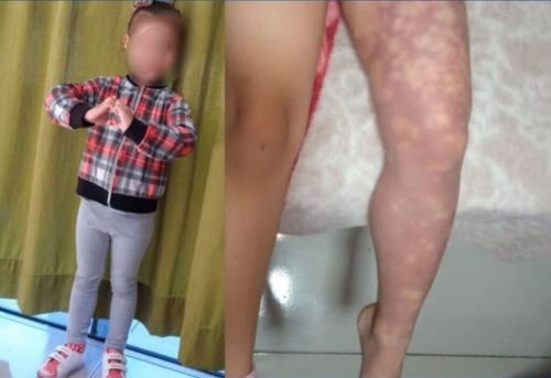 Ministério Público investiga caso de menina que teve perna amputada após receber injeção em SC