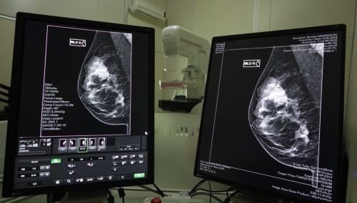 Governo do Estado lança mutirão de mamografias no mês da Mulher 
